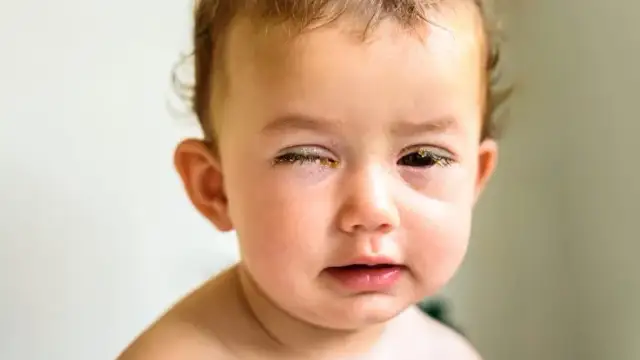 Zapalenie spojówek u dziecka - kiedy można wychodzić na dwór?