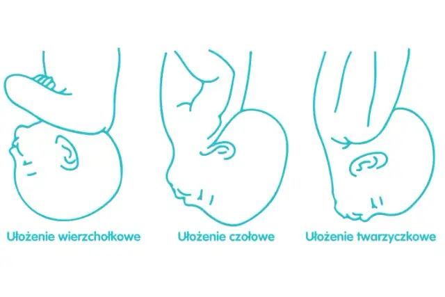 Jak rozpoznać ułożenie dziecka do porodu i uniknąć komplikacji?