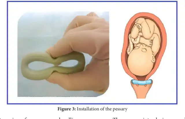 Kiedy poród po zdjęciu pessara? Wszystko, co musisz wiedzieć o pessarze i terminie porodu