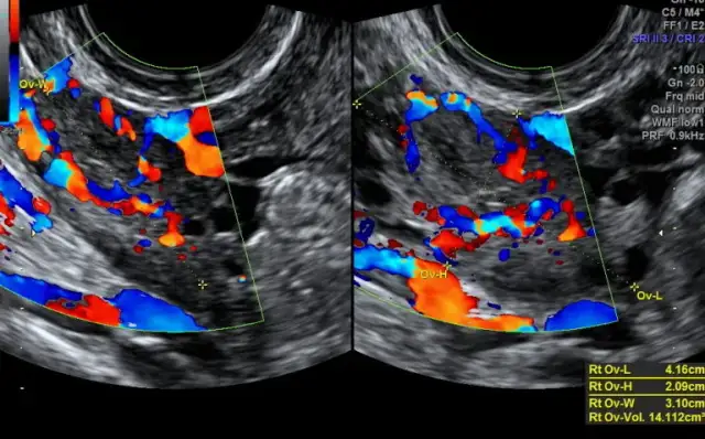 Jak wygląda owulacja na usg i co oznaczają wyniki dla płodności