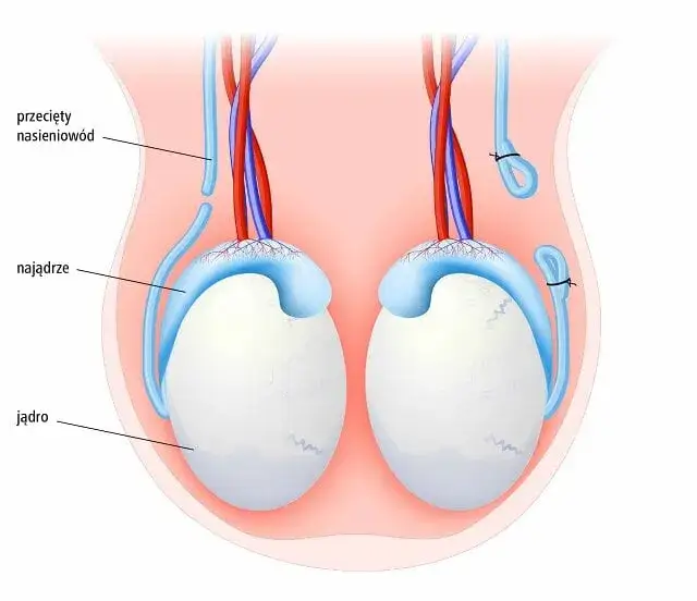 Skutki uboczne wazektomii: co musisz wiedzieć przed zabiegiem