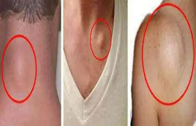 Tłuszczak – do jakiego lekarza się udać? Objawy, diagnoza i leczenie tłuszczaka