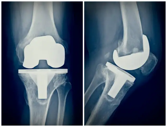 Jakie badania przed endoprotezą kolana? Lista i zalecenia przed operacją