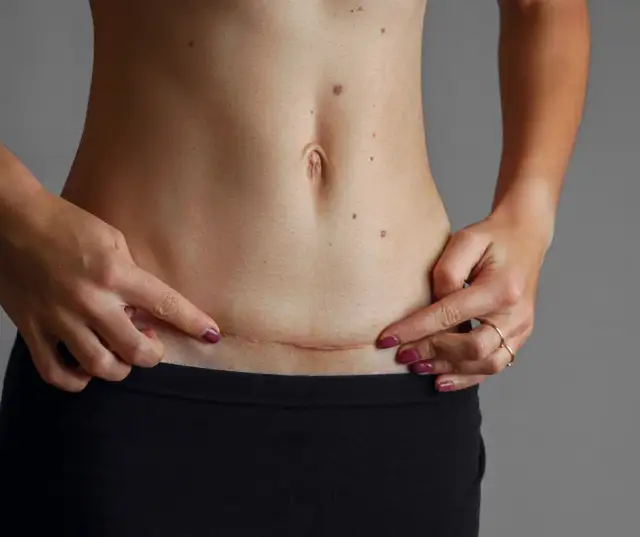 Kiedy można się golić po cesarce? Sprawdź, by uniknąć podrażnień