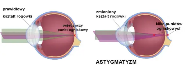 Największa wada wzroku: jakie powikłania grożą Twoim oczom?