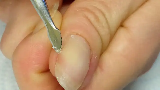 Jak obciąć skórki na paznokciach bez ryzyka uszkodzenia?