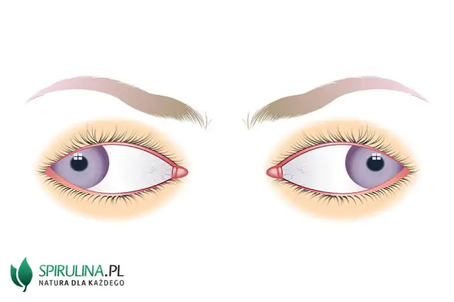 Co to jest zez rozbieżny? Objawy, przyczyny i skuteczne leczenie