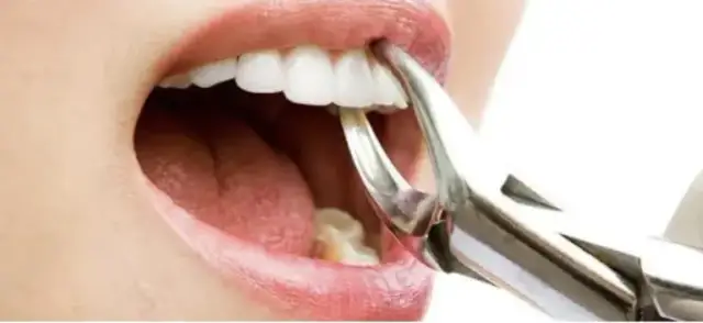 Ile trwa wyrywanie zęba 5? Sprawdź, jak uniknąć bólu i długiej rekonwalescencji