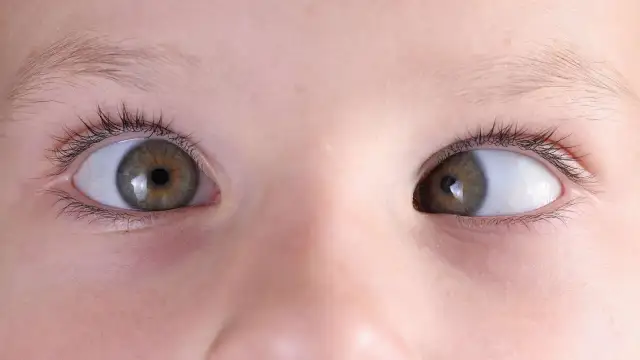 Jak skutecznie leczyć zez? Sprawdzone metody i porady dla Ciebie