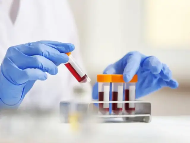 Co to jest ASO w badaniu krwi? Normy, interpretacja i znaczenie diagnostyczne