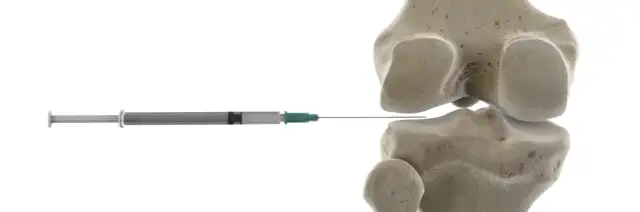 Czy zastrzyki z kwasu hialuronowego są refundowane przez NFZ?