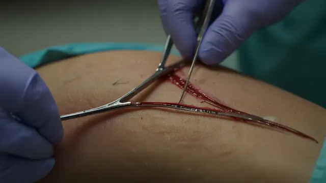 Jaka rana wymaga szycia? Najważniejsze informacje i wskazówki dotyczące leczenia