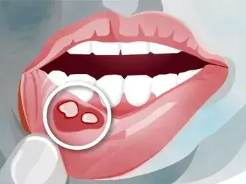 Skuteczne domowe sposoby na ból dziąseł – jak szybko złagodzić dyskomfort