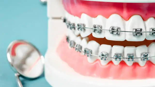 Ile naprawdę kosztuje aparat na dolne zęby? Sprawdź, jak uniknąć ukrytych kosztów!