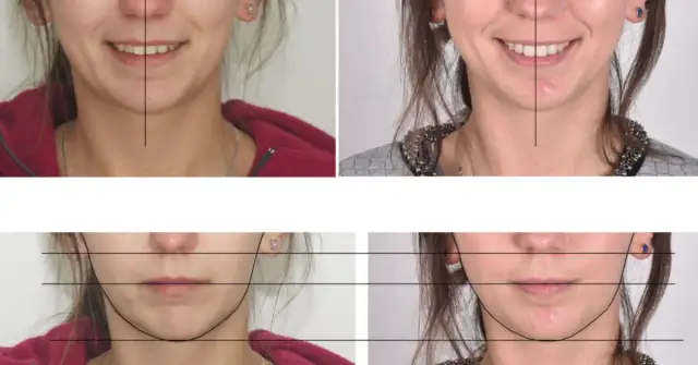 Czy aparat na zęby naprawdę zmienia kształt twarzy? Sprawdź, jak wpływa na rysy