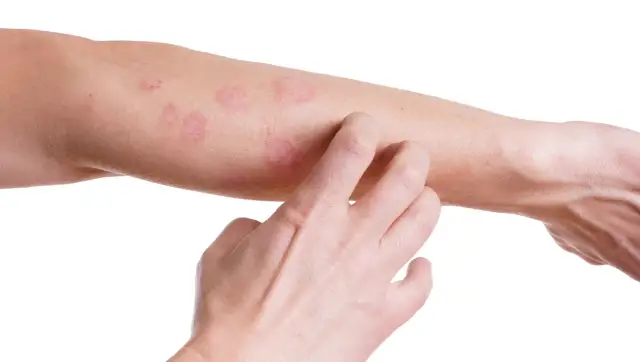 Skutki uboczne po chemii – najczęstsze objawy i jak sobie z nimi radzić