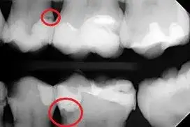 Jak odczytać próchnicę na RTG zęba i uniknąć poważnych problemów stomatologicznych