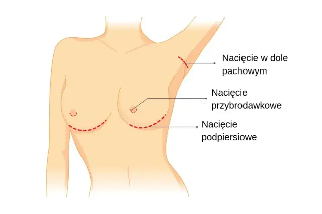 Gdzie zrobić operację biustu? Znajdź najlepsze kliniki w Polsce