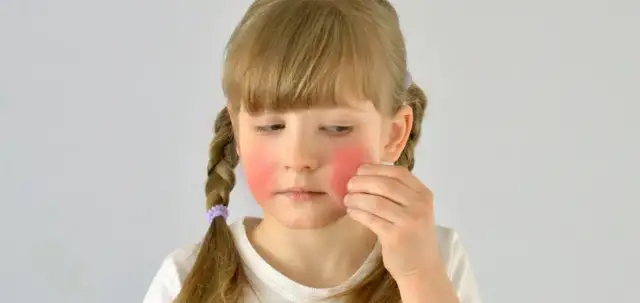 Choroba róża: skąd się bierze i jak uniknąć zakażenia?