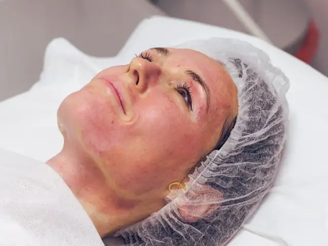 Czy można pić alkohol po dermapenie? Sprawdź skutki i zalecenia eksperta