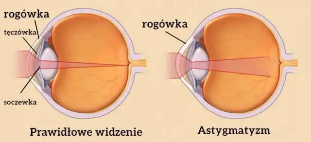 Czy astygmatyzm może się zmniejszyć? Poznaj prawdę o leczeniu i wieku