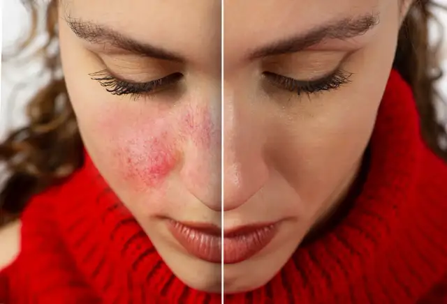 Jak wygląda cera naczynkowa? Objawy i skuteczne metody pielęgnacji