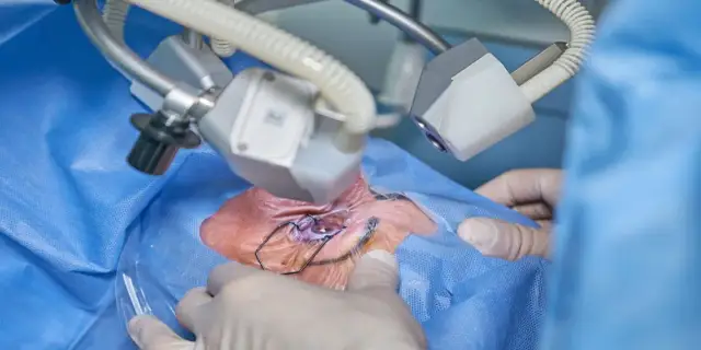 Czy operacja zaćmy może się nie udać? Poznaj ryzyka i powikłania