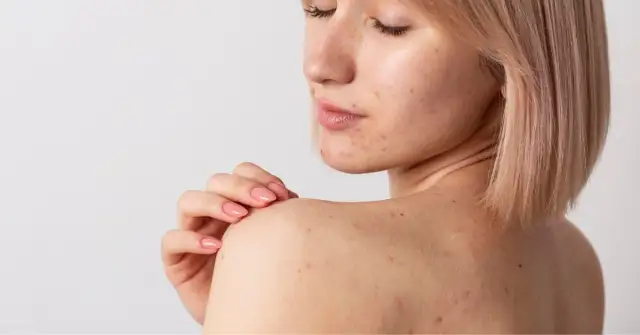 Jak pozbyć się śladów po pryszczach – skuteczne metody i porady