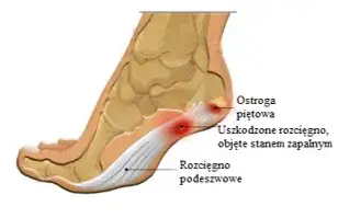 Ból pięty: poznaj przyczyny i skutki, które mogą cię zaskoczyć
