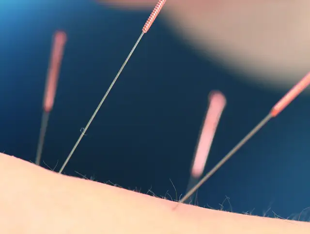 Akupunktura na kręgosłup szyjny: Jak złagodzić ból i napięcie?