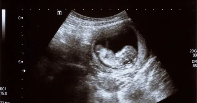 Jak wygląda dziecko w 7 tygodniu ciąży? Niesamowite zmiany w twoim brzuchu