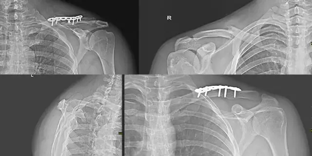 Ile trwa rehabilitacja po złamaniu obojczyka i co warto wiedzieć?