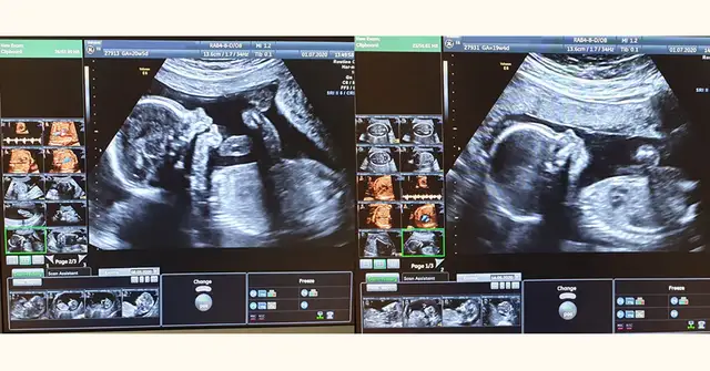 Badania prenatalne w 12 tyg. ciąży: USG genetyczne i PAPP-A bez obaw