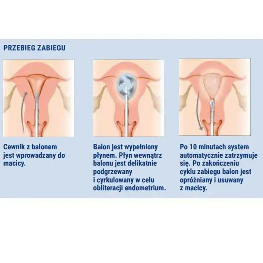 Histerektomia nadszyjkowa a miesiączka: Czy krwawienia wrócą?