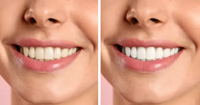 Jak uśmiechać się z zębami? Pokonaj wstyd i ćwicz naturalność!