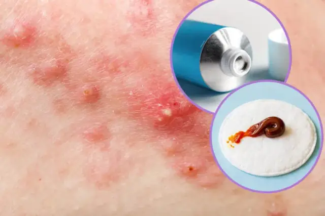 Jak długo trzymać maść ichtiolową na pryszcze, by uniknąć blizn?