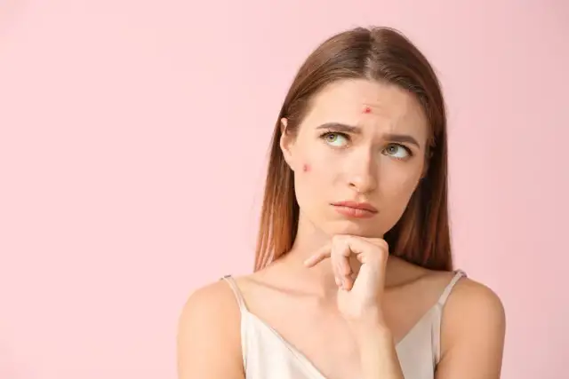 Jak zapobiec trądzikowi? Kompletny przewodnik po zdrowej cerze