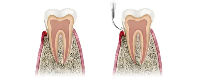 Jak skutecznie usunąć ropę na dziąśle i uniknąć poważnych problemów