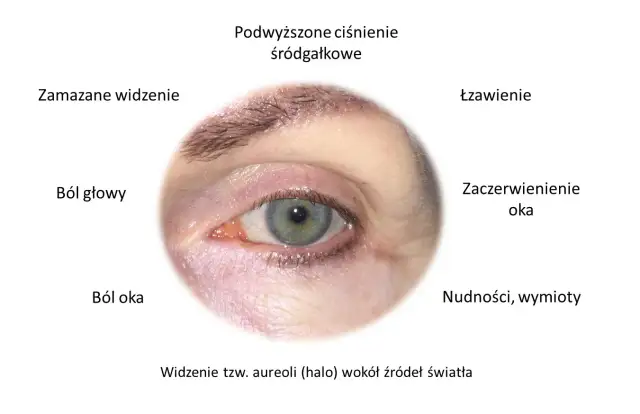 Jaskra objawy początkowe: Jak rozpoznać cichego złodzieja wzroku?