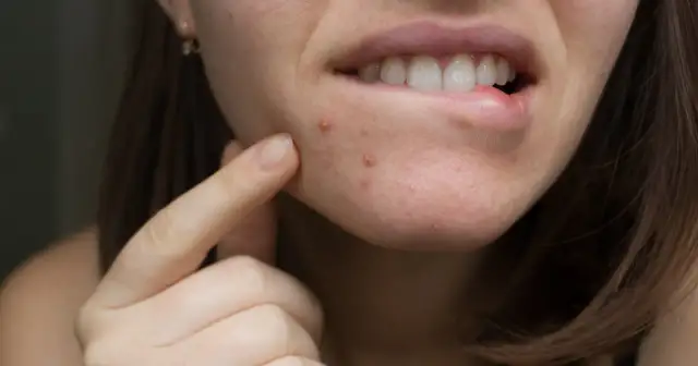 Pryszcze na twarzy? Skuteczne domowe sposoby i co unikać!