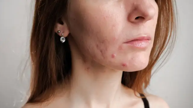 Blizny po pryszczach? Skuteczne metody na gładką cerę i jak im zapobiegać