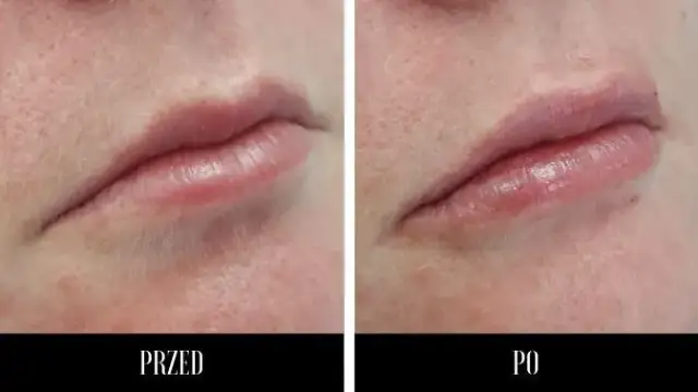 Kwas hialuronowy do ust: Jak wybrać idealny dla naturalnego wyglądu?