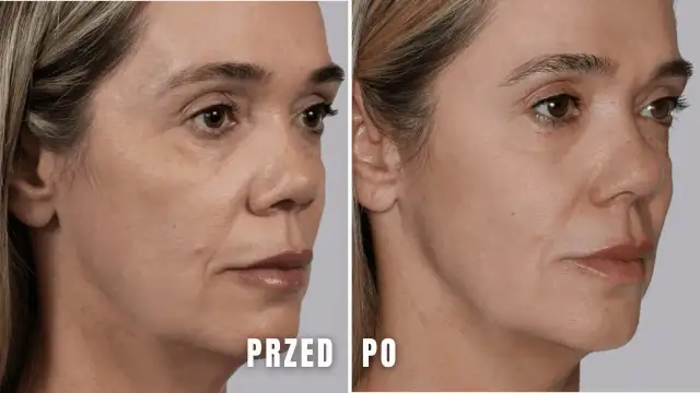 Porównanie skóry kobiety przed i po zabiegu kosmetycznym.