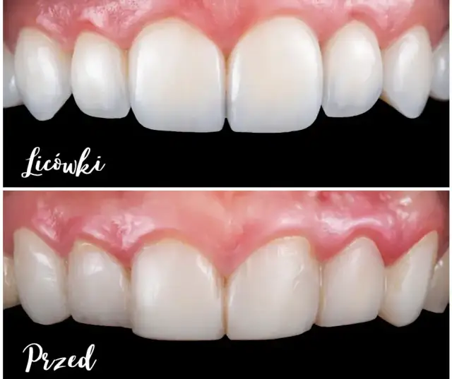 Ile kosztują licówki w Polsce? Porównanie cen i ukryte koszty.