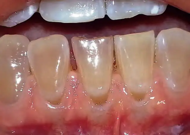 Przeszczep dziąsła: czy warto? Pełny przewodnik po zabiegu.