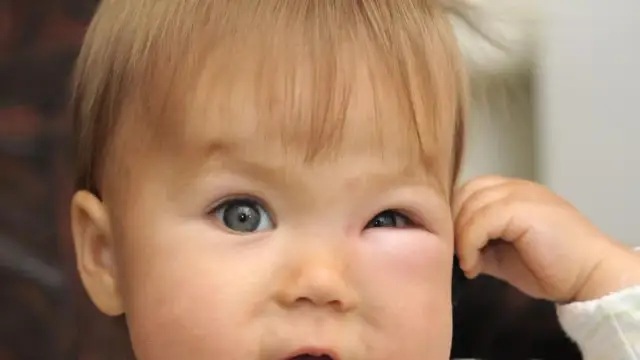 Spuchnięte oko u dziecka – co robić, aby złagodzić objawy?