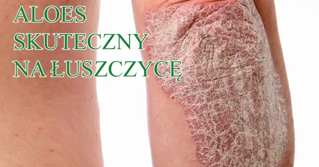 Czy jest nowy lek na łuszczycę? Odkryj najnowsze terapie i ich skuteczność