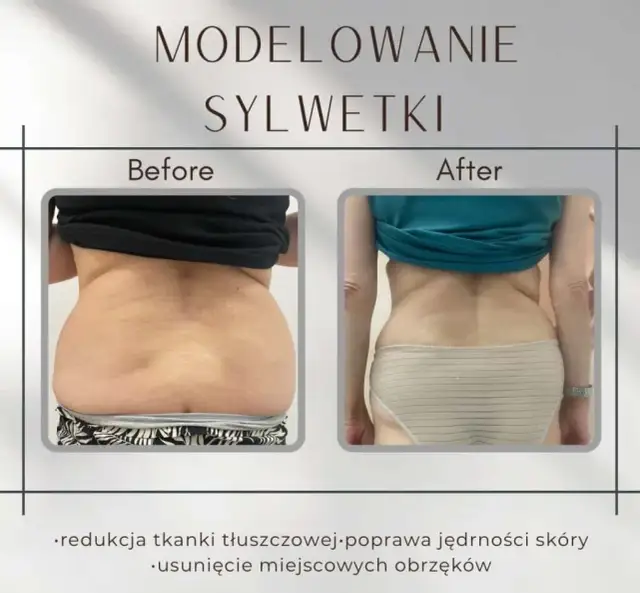 Liposukcja: co to? Modelowanie sylwetki, metody, ceny ekspert radzi