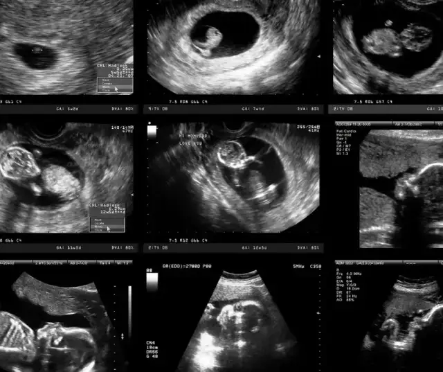 Kiedy widać ciążę na usg? Odkryj kluczowe momenty w ciąży