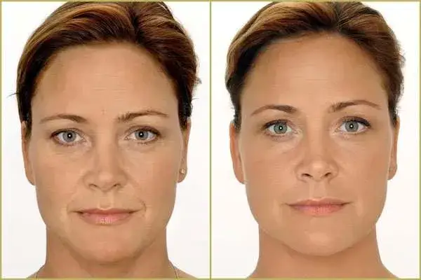 Zmarszczki palacza: Botox czy kwas hialuronowy - co wybrać?